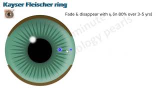 Corneal pigment lines | Kayser Fleischer ring  | Fleischer ring