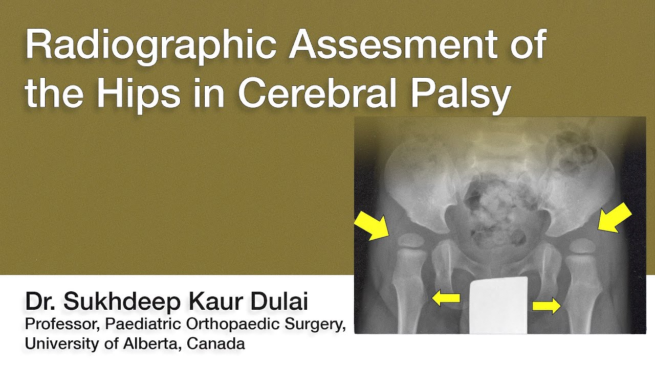 Radiographic Assessment of the Hips in Cerebral Palsy