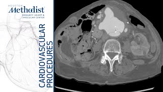 Download Lagu Endovascular Repair of Complex Contained Abdominal Aortic Rupture (Lumsden MD, Zubair MD, Gomez MD) Thumbnail