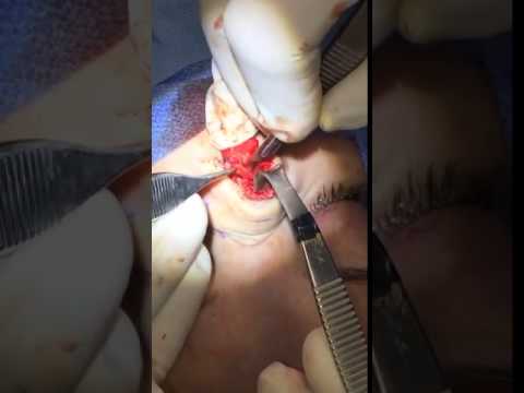 Open rhinoplasty 7