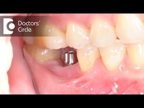 YouTube video about: How long can you wait to get a tooth implant?