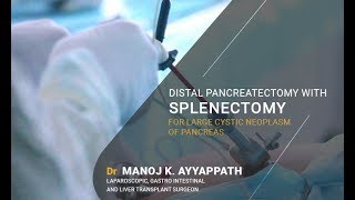 Laparoscopic Distal Pancreatectomy With Splenectomy For Large Cystic Neoplasm Of Pancreas