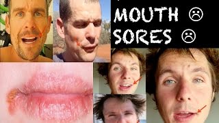 VEGAN MOUTH SORES :(