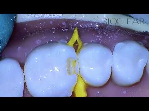 Bioclear Matrix | Class II Preparation