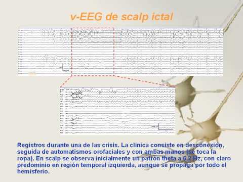 paciente con epilepsia del lóbulo temporal