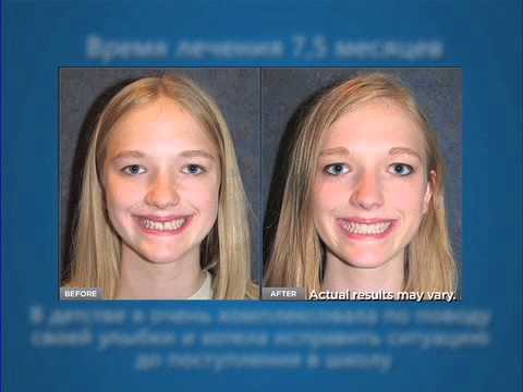 Invisalign Lobby Video