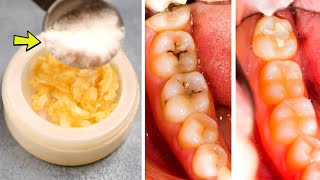 How to get rid of cavities - Remove tooth decay yourself and stop spreading naturally at home