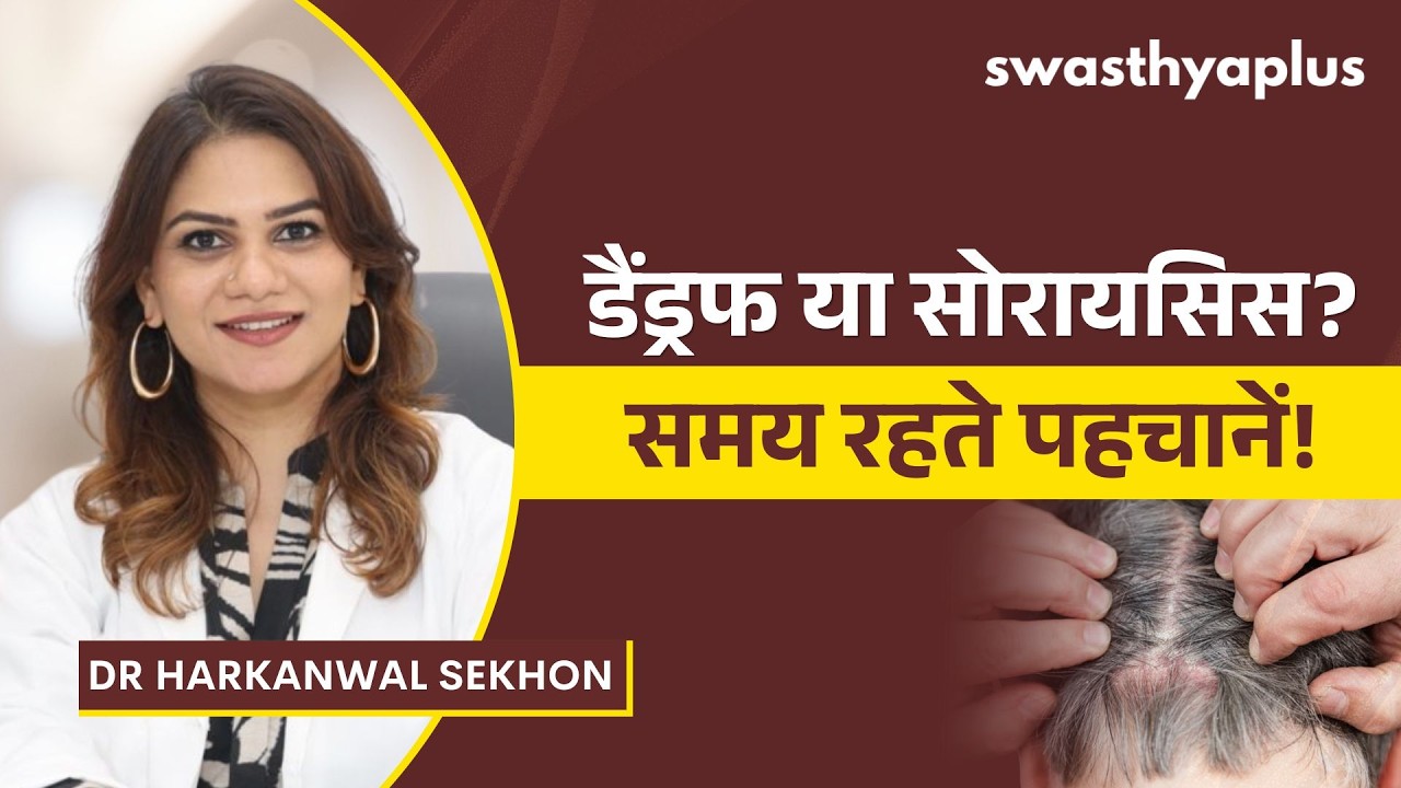 स्कैल्प सोरायसिस: इलाज क्या है? | Scalp Psoriasis: How to Treat? in Hindi | Dr Harkanwal S