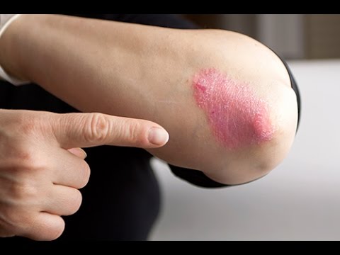 comment soigner plaque d'eczema