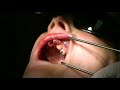 Lateral Upper Anterior Tooth Extraction, broken at gumline, curved root