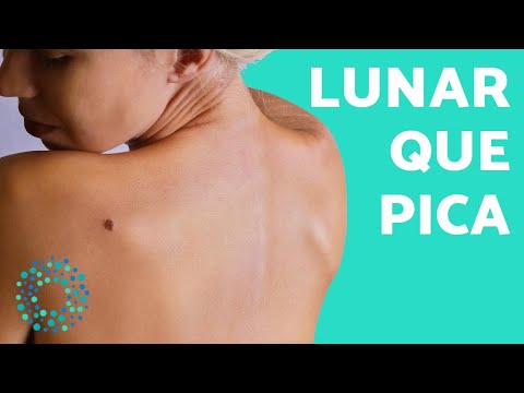 download lagu mp3 mp4 Lunares Que Pican, download lagu Lunares Que Pican gratis, unduh video klip Lunares Que Pican