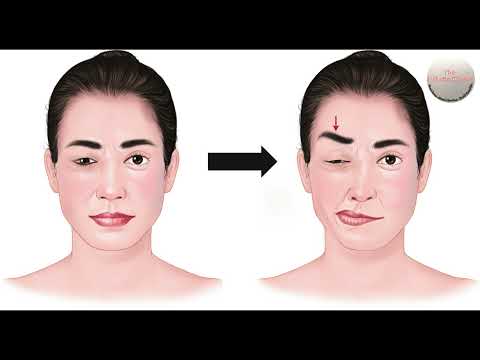 Treatment of Hemifacial Spasm & Benign Essential Spasm with Botulinum Toxin Injections in India