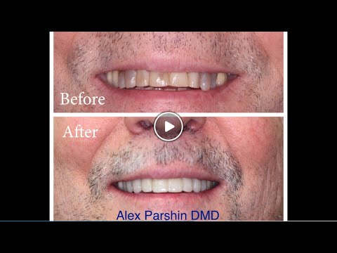 download lagu mp3 mp4 Staten Island Veneers, download lagu Staten Island Veneers gratis, unduh video klip Staten Island Veneers