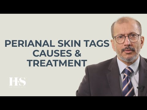 Perianal Skin Tags Explained | Causes, Treatment & Removal | Mr Sanjay Chaudhri | The Health Suite