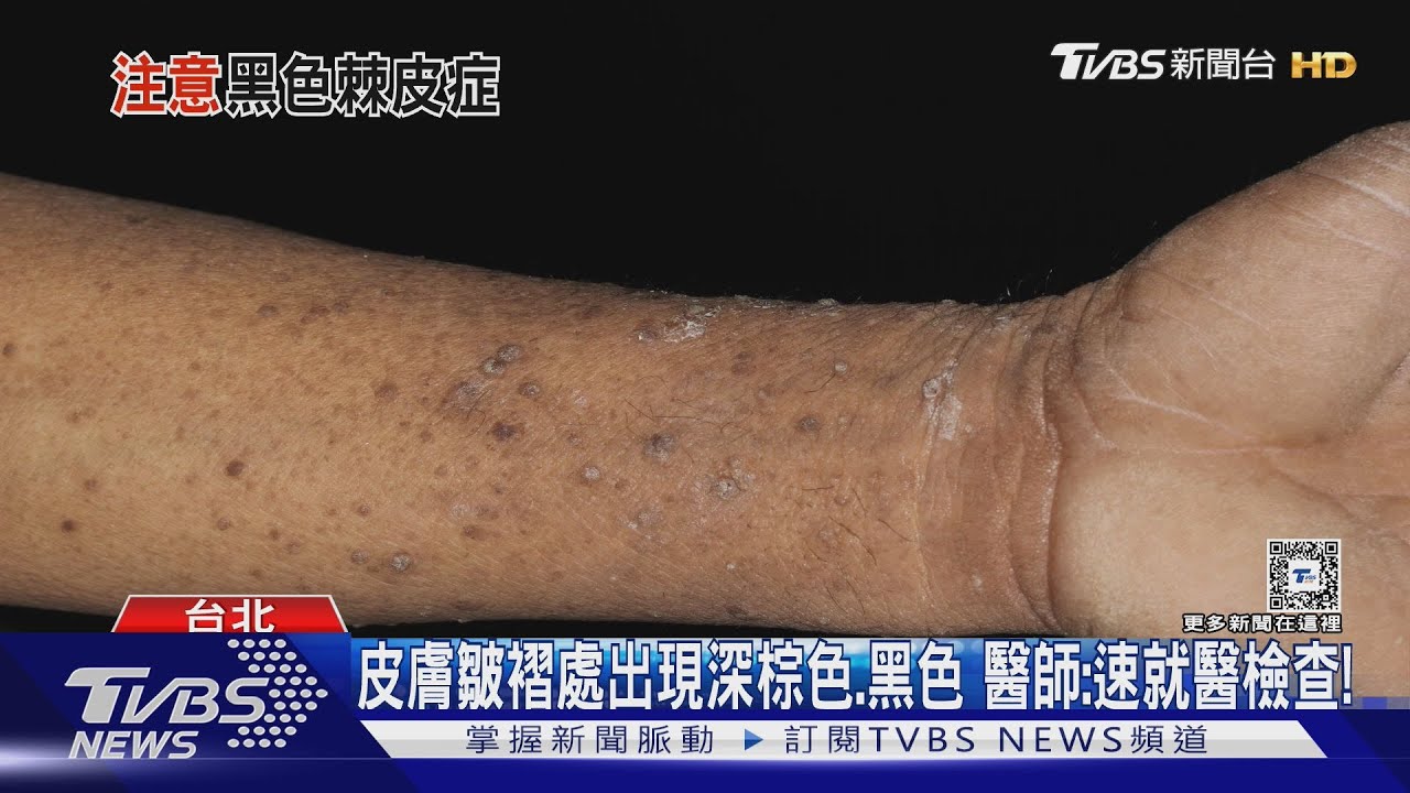身體「這幾處」突然變黑 竟洗不掉!恐罹「這疾病」下場慘