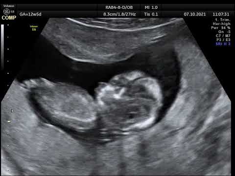 Ultrazvučni pregled trudnice u 12 nedelji trudnoće.Ginekološka ordinacija Anđelić. Vođenje trudnoće.