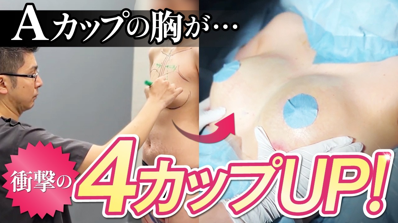 ハイブリッド豊胸で授乳後の胸が4カップUP！経過・効果の1ヶ月レポート
