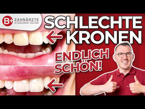 Schlechte Zahnkronen auf Schneidezähnen ÄSTHETISCH gestalten! Endlich schöne Frontzahn-Kronen!