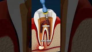 Are you having that black tooth decay?If yes, then book your appointment today! #oralhealth #dentist