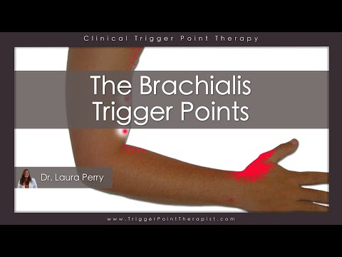 a brachialis artrózisa