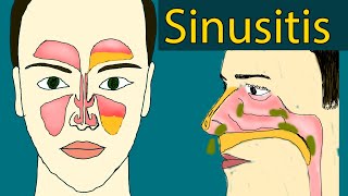 Sinusitis - Symptoms and treatment;  Sinus Infection, Chronic sinusitis