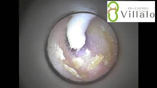 耳掃除動画vol.32「こびりついた耳垢」