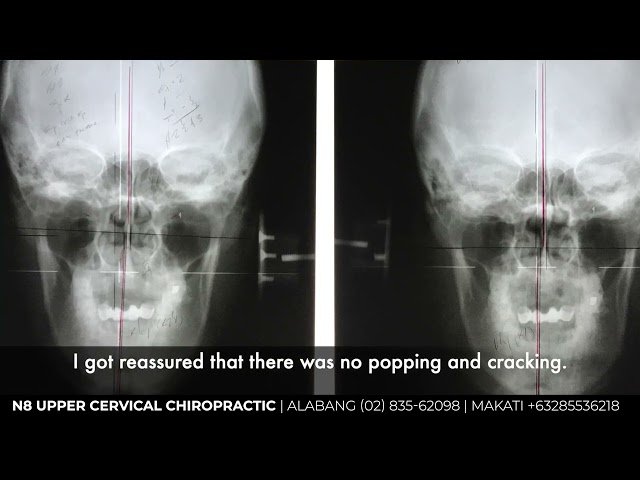 Upper Cervical Care for Neck Pain Radiculopathy