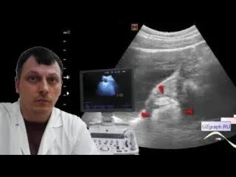 Pediatric Female pelvic ultrasound - Lesion of the ovary with a donut sign