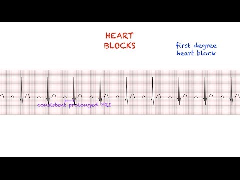 Heart Blocks Interpretation: Easy and Simple