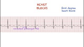 Heart Blocks Interpretation made easy