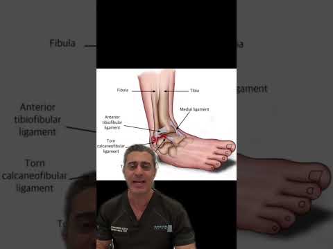 SEVERE Ankle Sprain #BackwardsShuffle