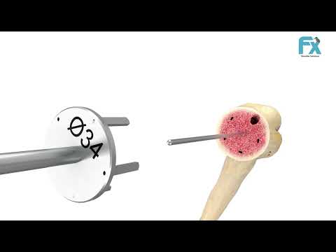 FX EasyTech Shoulder System -  Medical Device Animation by Pulse 3D Media