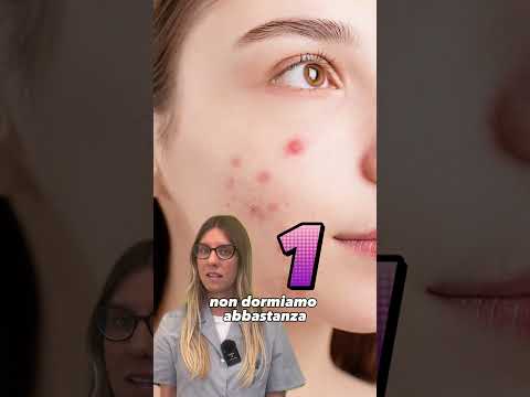 🤔 Conosci davvero le cause dell'acne? 👉 Ecco alcune di esse!