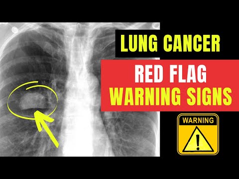 How to spot RED FLAG warning signs & symptoms of LUNG CANCER... Doctor O'Donovan explains