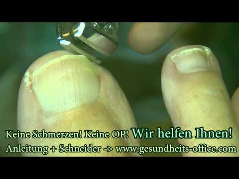 Gomeopatitscheskije die Präparate von gribka auf dem Nagel Wie gribok auf dem Nagel des Beines heilen wird