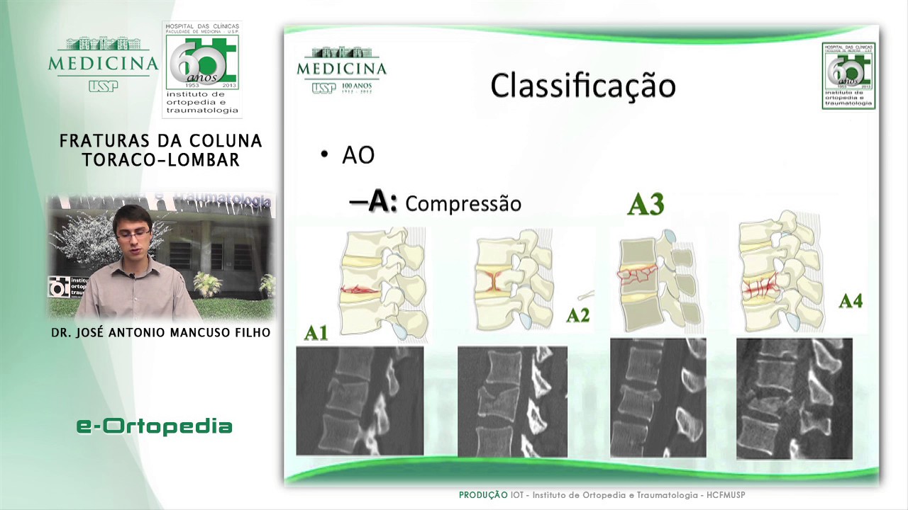 Fratura Coluna Toraco-Lombar Sacro - Dr. José Antonio Mancuso Filho