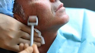 Microagulhamento facial: Vale a pena fazer?