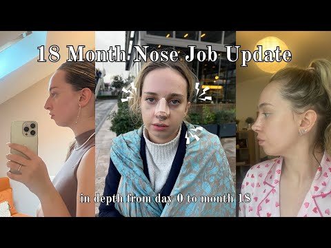I Got A Nose Job - 18 Month Update