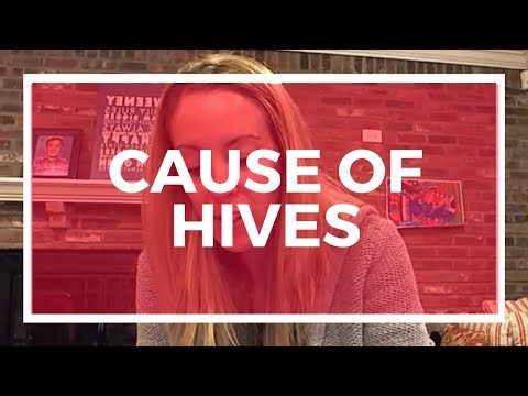 FINALLY Found Out The Cause Of My Hives! You Won't Believe It