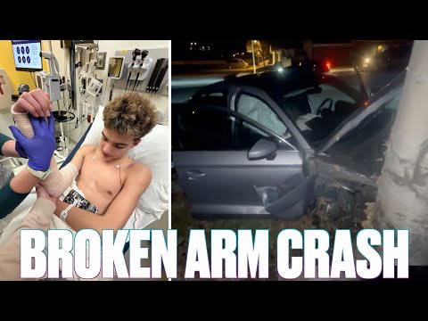 ARM BROKEN IN TWO PLACES AFTER SCARY CAR CRASH ONE DAY BEFORE FACE SURGERY