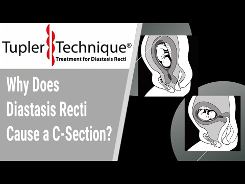 Why Does Diastasis Recti Cause a C-Section?