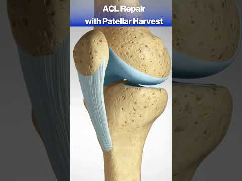 What happens when you tear your ACL? #acl #knee #kneepain