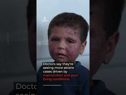 Gaza’s displaced families face worsening living conditions