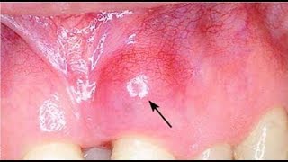how to get rid of abscess on gum at home
