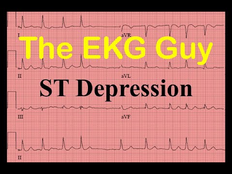 EKG/ECG ST-segment Depression - Question 15.0 | The EKG Guy