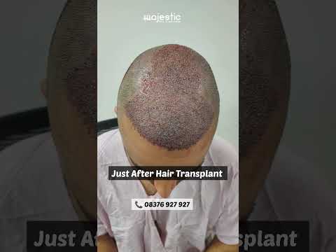 How does the hair look within 10 days of Hair Transplant|☎️08376927927 #prp #hairloss #baldness