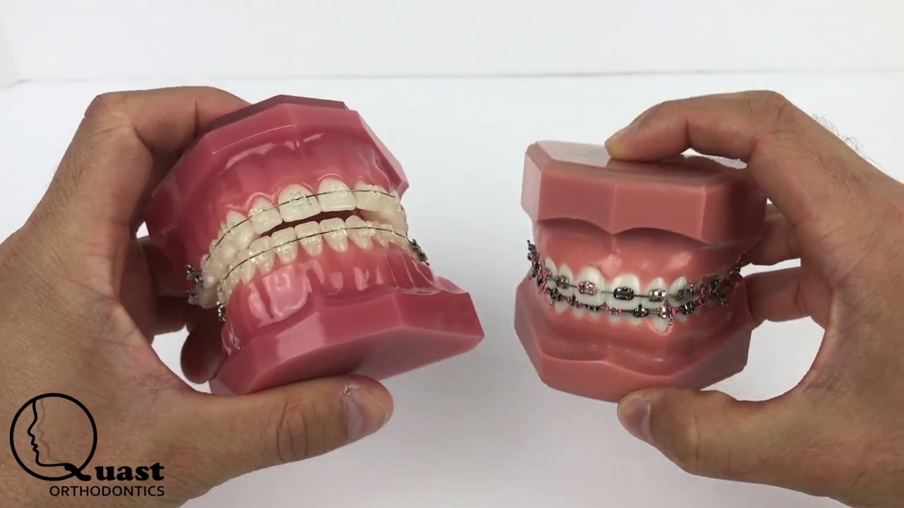 Ceramic Braces vs Metal Braces