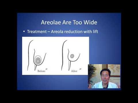 How Can I Fix Wide Areolas - Areola Surgery Consultation - Dr. Anthony Youn