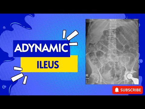 Adynamic Ileus