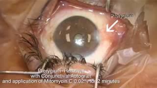 Pterygium removal with conjunctival autograft and mitomycin C.  Shannon Wong, MD 5-28-17